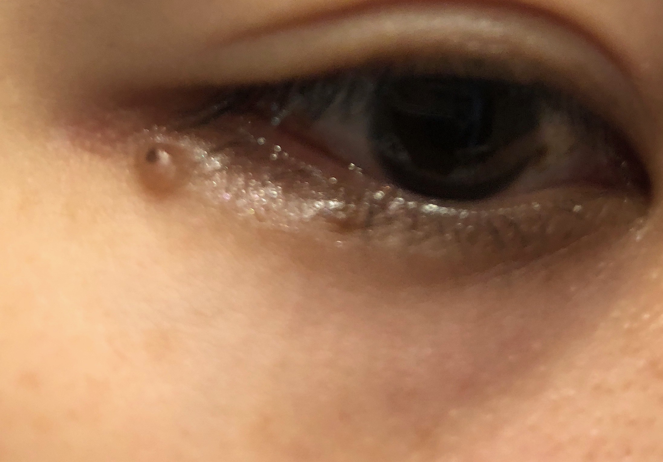 目の下のほくろ除去 症例 経過 半年後の傷跡写真とともにレポート かほブログ